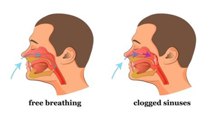 Why are my sinuses always blocked?