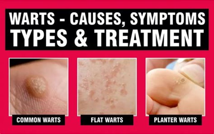 Why are my warts spreading?