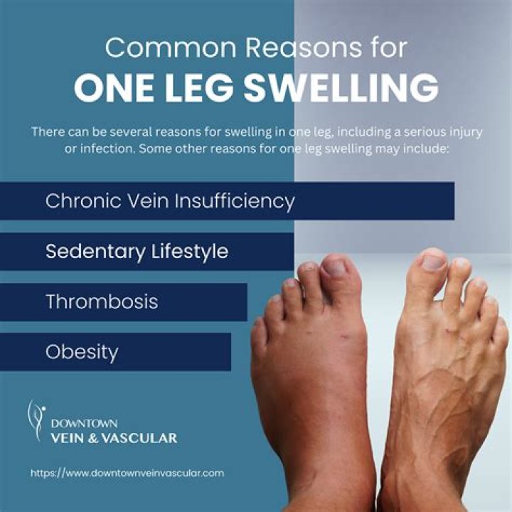 Why do legs swell on long flights?