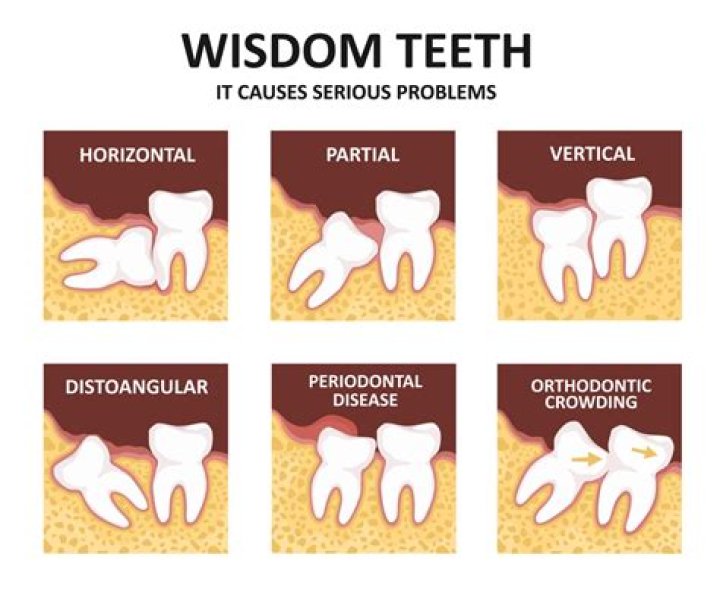 Why do wisdom teeth come?