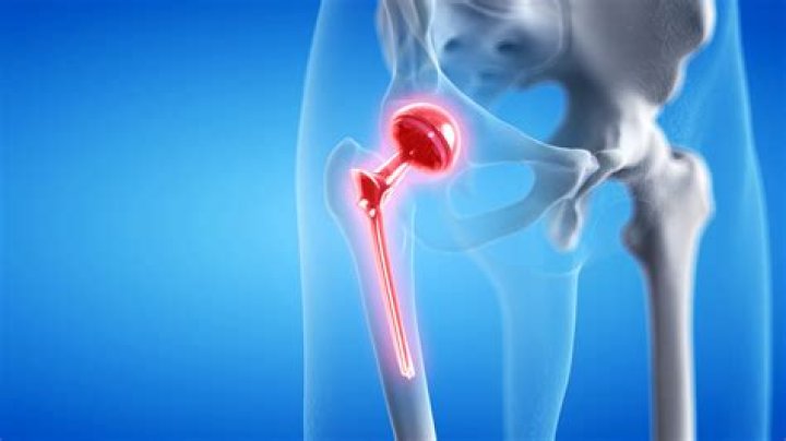 Why is my leg swollen after hip replacement?