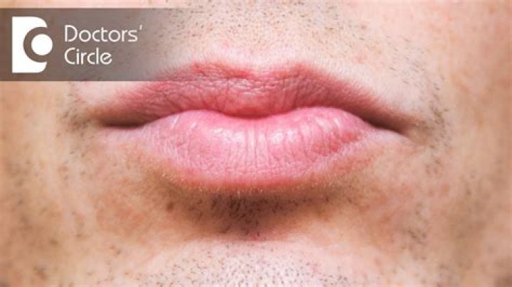 Why is my top lip dark?