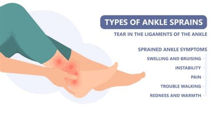 Will my ankle ever be the same after a sprain?